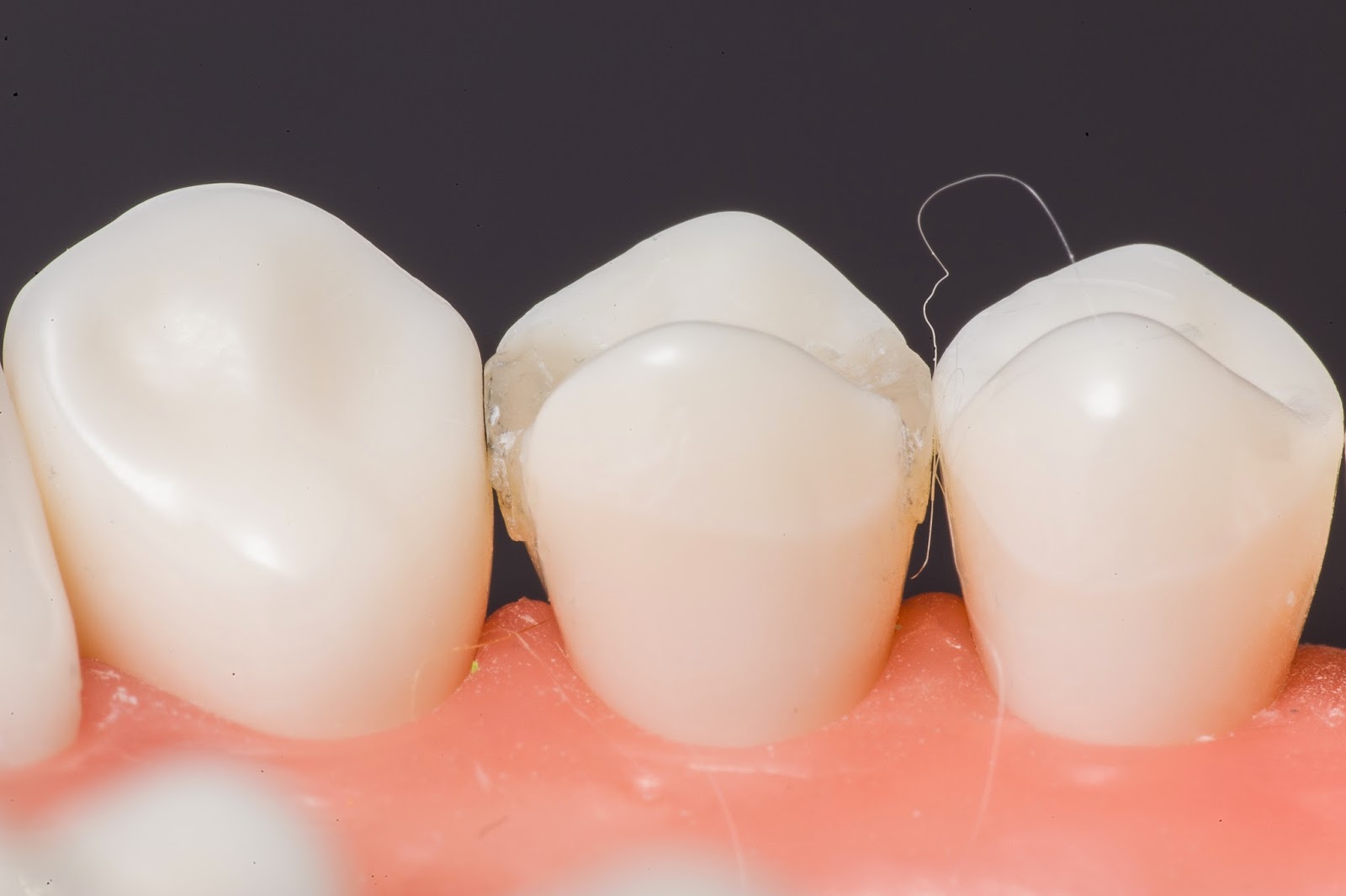 Operative Practical 14 MO Prep and 12 MOD Composite Fill