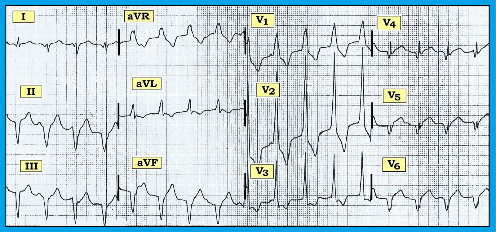 ECG Interpretation ECG Blog 134 — Is there AV Dissociation?