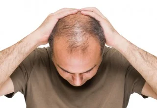 Tips Alami Mencegah Kebotakan Rambut