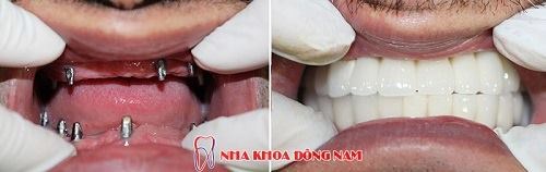 CẮM GHÉP IMPLANT KHÔNG ĐÚNG QUY TRÌNH VÀ NHỮNG BIẾN CHỨNG -9