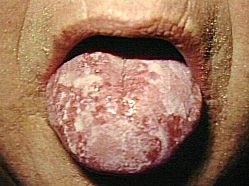 what is gonorrhea health and lifestyle