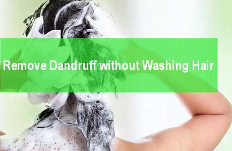Get Rid of Dandruff without Washing Hair remove dandruff flakes without washing hair