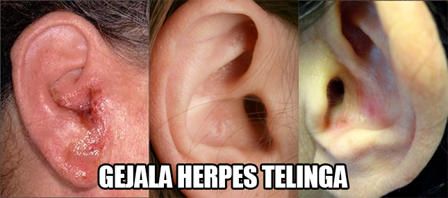 Situs Obat Herbal: lingkaran bintik-bintik pada telinga kanan | herpes
