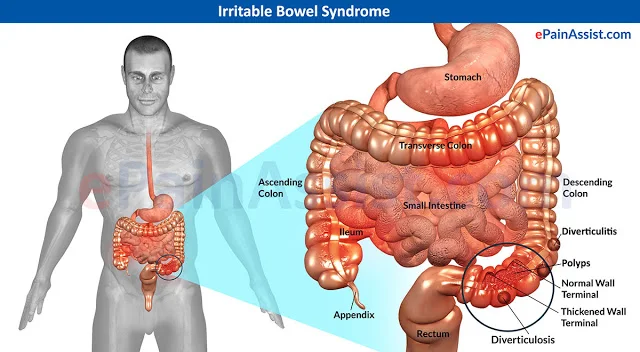 Irritable-Bowel-Syndrome