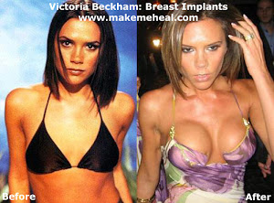 The Victoria Beckham Breast Implant Cup Game?