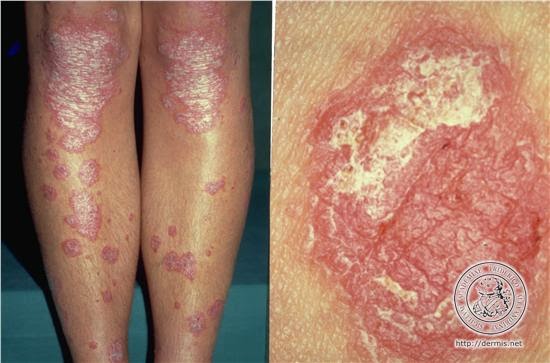 psoriasis sedef hastaligi tedavi