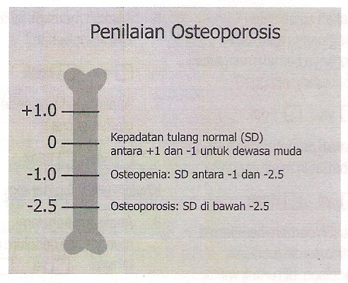 Mau Sehat: Tes kepadatan tulang Mau Sehat: Tes kepadatan tulang
