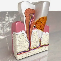 problèmes de plaque dentaire