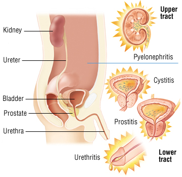 Krónikus pyelonephritis prosztatitis, Epidymitis prosztatagyulladás