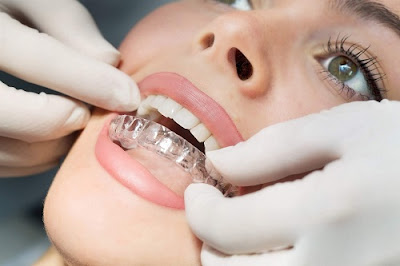 Hậu quả niềng răng sai cách là gì?
