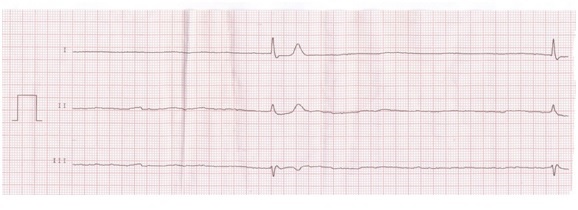 Bradycardia