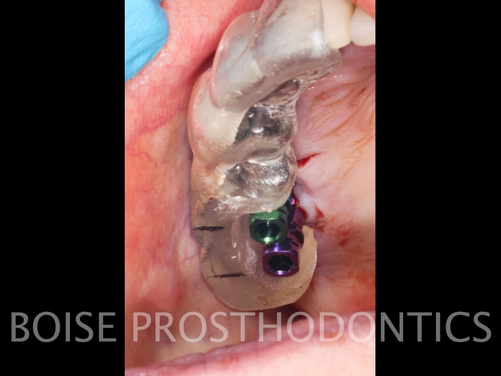 Boise Idaho Prosthodontics Posterior Provisional Zimmer Implant