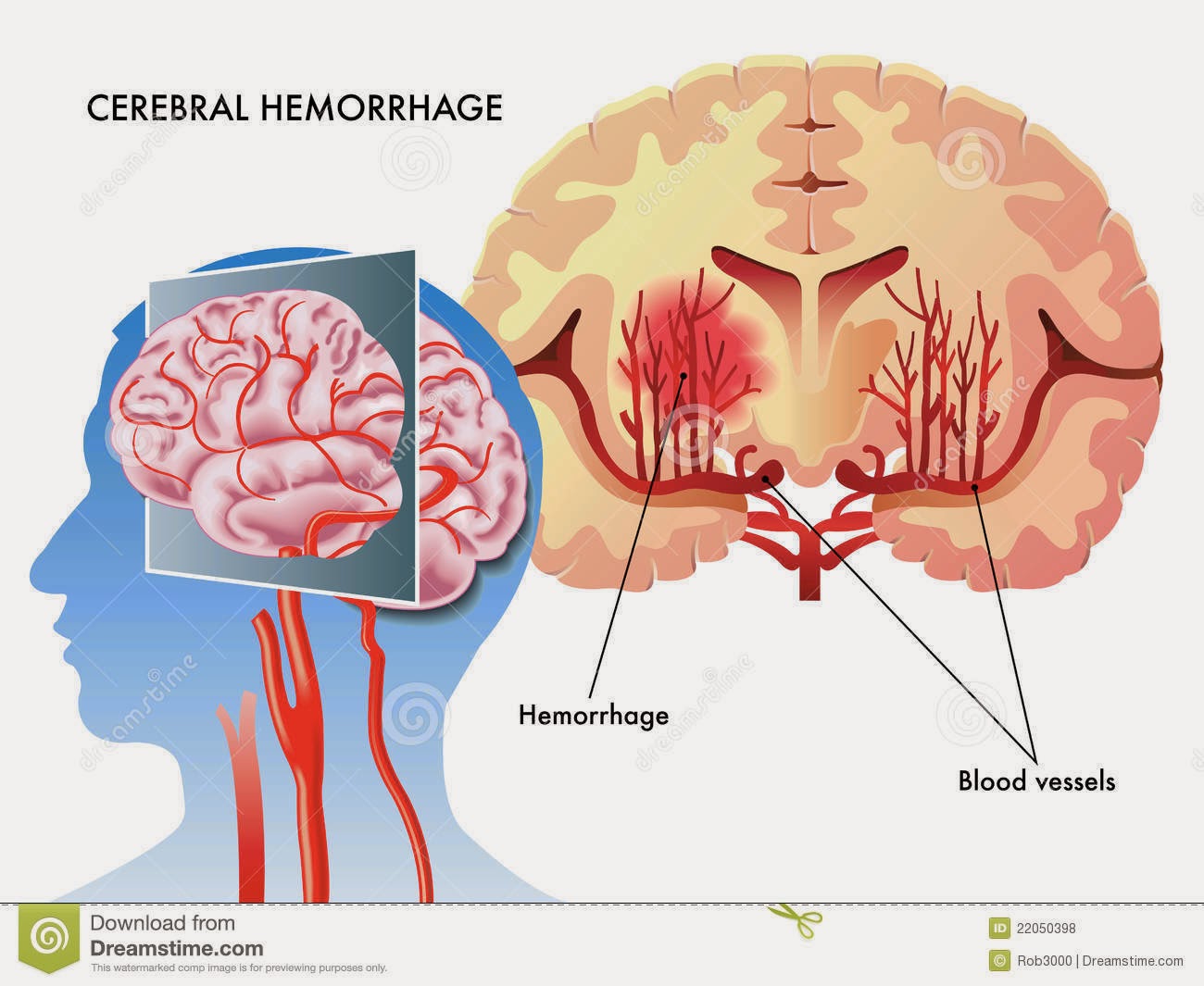 Dr Sherazi Cerebral hemorrhage