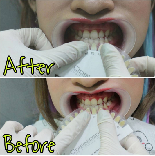 Pengalaman Bleaching Gigi di Jakarta Smile Dental indonesia beauty and