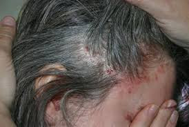 RAMUAN TRADISIONAL OBAT EKSIM DI KEPALA SUPER AMPUH RAMUAN TRADISIONAL OBAT EKSIM DI KEPALA SUPER AMPUH