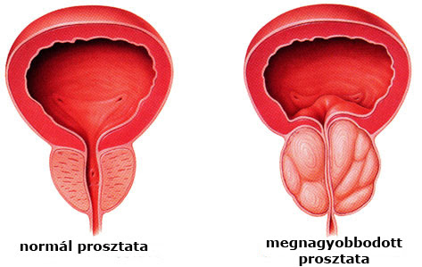 Prostata panaszos férfiak, figyelem!