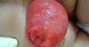 Things that cause anal prolapse