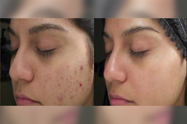Beauty01 3 Cara Mudah Membuat Masker Tomat Untuk Menghilangkan Bekas Jerawat Yunike Fabiola Youtube