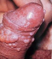 Image TANDA RATA RATA PENYAKIT SIPILIS | OBAT SIPILIS