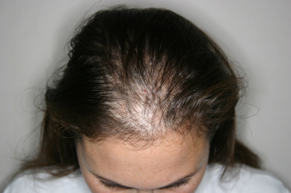 Hair regrowth after telogen effluvium - Answers on HealthTap