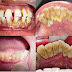 Cao răng gây ra tác hại gì?