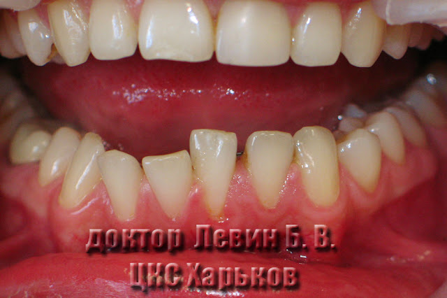 Бутираты лечение