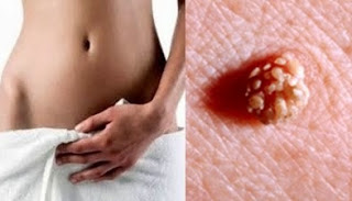 Foto Cara Pemesanan Obat Kutil Kelamin