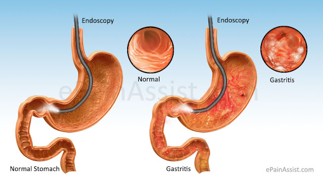 DE ANATOMIE EN PATHOLOGIE VAN DE MAAG GASTRITIS de-anatomie-en-pathologie-van-de-maag-gastritis