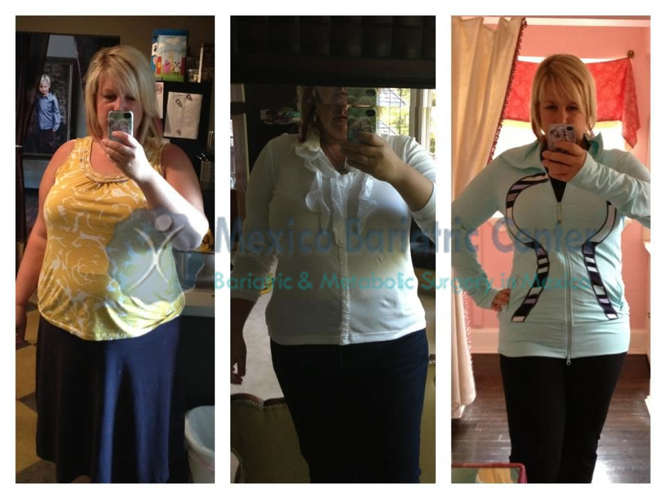 Infertility In Polycystic Ovary Syndrome Pcos And Weight Loss Surgery