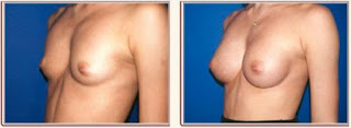 augmentation mammaire femme avant et après