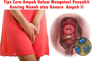 Obat Kencing Nanah Murah dan Manjur