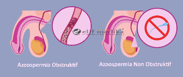 Pengobatan Azoospermia Obstruktif Tanpa Operasi
