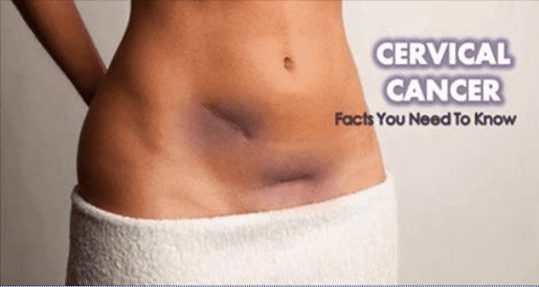 ROMPIENDO: CNN - 7 SIGNOS DE CÁNCER CERVICAL QUE LAS MUJERES NECESITAN OBSERVAR ROMPIENDO: CNN - 7 SIGNOS DE CÁNCER CERVICAL QUE LAS MUJERES NECESITAN OBSERVAR