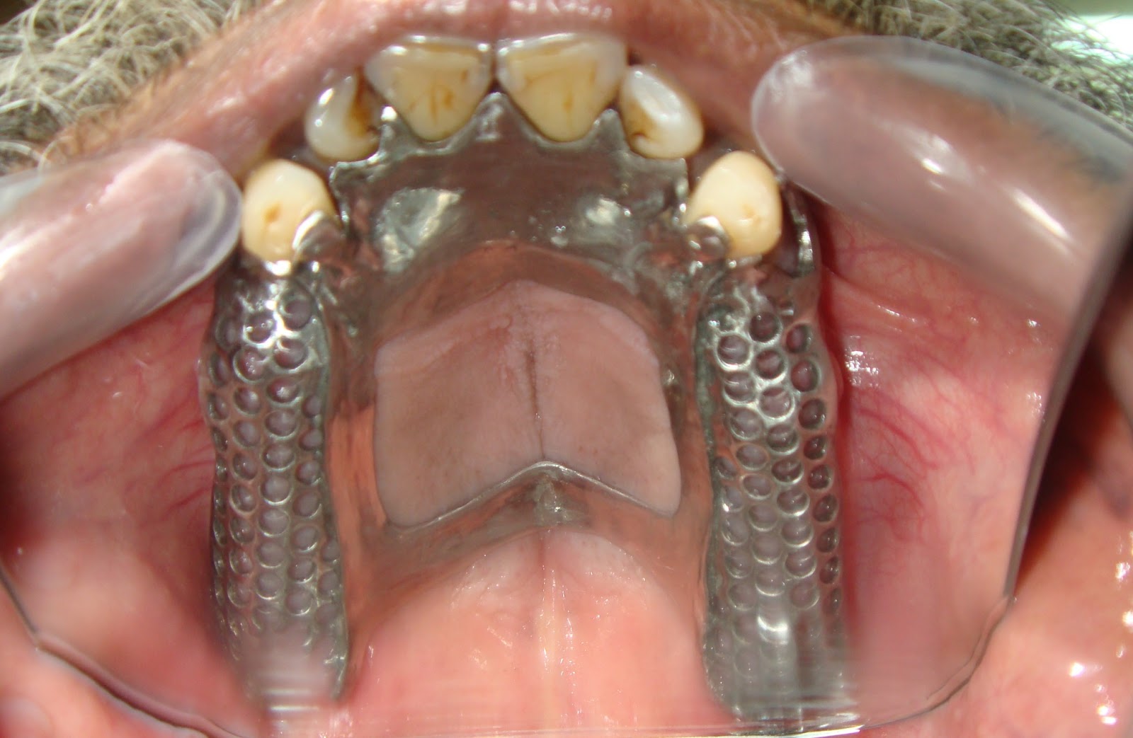 Understanding Prosthodontics Tagore Dental College & HospitalBy Department of Prosthodontics