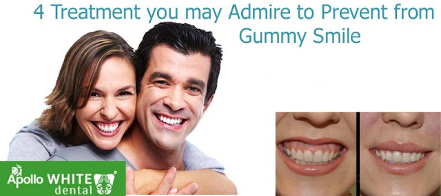 4 Treatment you may Admire to Prevent from Gummy Smile