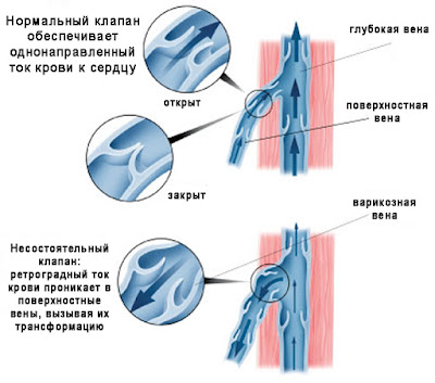 Несостоятельный клапан вены
