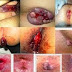 Ciri-ciri Wasir Ambeven Dalam dan Luar thumbnail