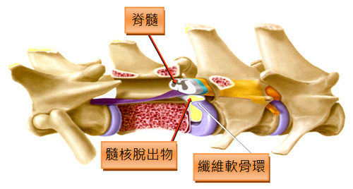 第一型椎間盤脫出示意圖。