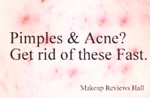 Best way to remove acne & pimples