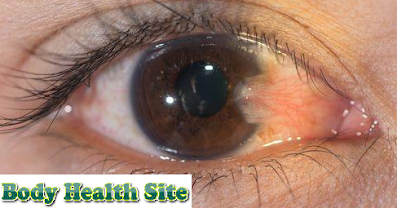 pterygium, pterygium surgery, pterygium eye, pinguecula vs pterygium, pterygium vs pinguecula, nail pterygium, pterygium nail, pterygium treatment, pterygium of eye, pterygium inversum unguis, eye pterygium, pterygium icd 10, pinguecula pterygium, pterygium symptoms, picture of pterygium eye, what is pterygium, pictures of pterygium eye, pterygium removal, pterygium pictures eye, early pterygium eye, pterygium pronounce, pterygium in spanish, pterygium treatments, pterygium eye drops, pterygium surgery cost, pterygium treatment eye drops, pterygium definition, pterygium eye surgery, pterygium causes, pterygium removal naturally, popliteal pterygium syndrome, pterygium excision, pterygium vs.pinguecula, multiple pterygium syndrome, pterygium eye web, pterygium surgery before and after, dorsal pterygium, pterygium treatment without surgery, pterygium pinguecula, ventral pterygium, pterygium surgery recovery photos, pterygium nails, pterygium early stages, pterygium syndrome, icd 10 code for pterygium, peripheral pterygium, pinguecula and pterygium, pterygium eyes, pinky toe nail pterygium, eye drops for pterygium, pterygium surgery near me, nasal pterygium, pterygium surgery recovery time, pterygium inversus unguis, pterygium photographs, pterygium surgery complications, pterygium images, pterygium colli,