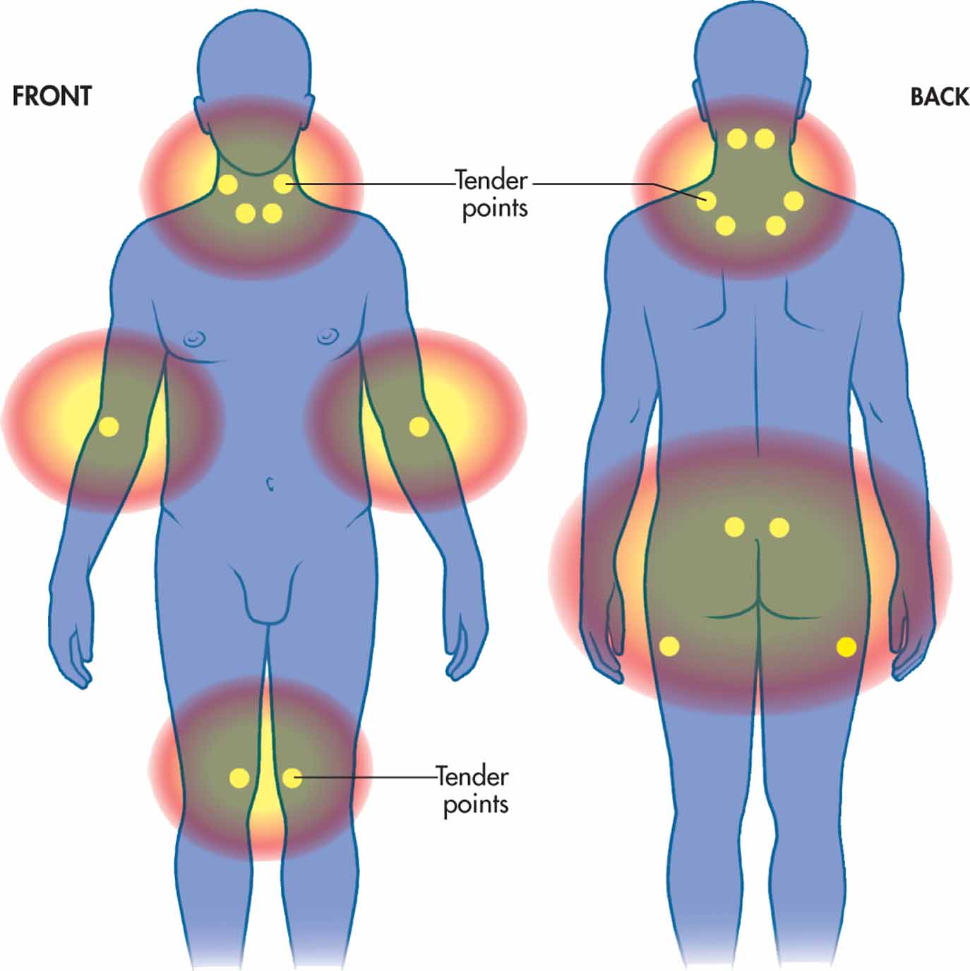 Puntos De Fibromialgia En Los Pies FIBROMIALGIA - PRESENTACION ANTE LA COMISION DEL TRABAJO DE LA HCDN