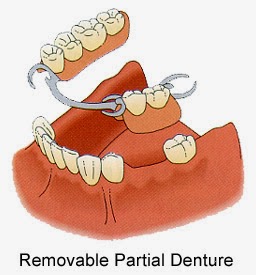 http://www.dentistinchennai.com/removable-denture.php