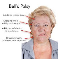 Penyakit Bell Palsy
