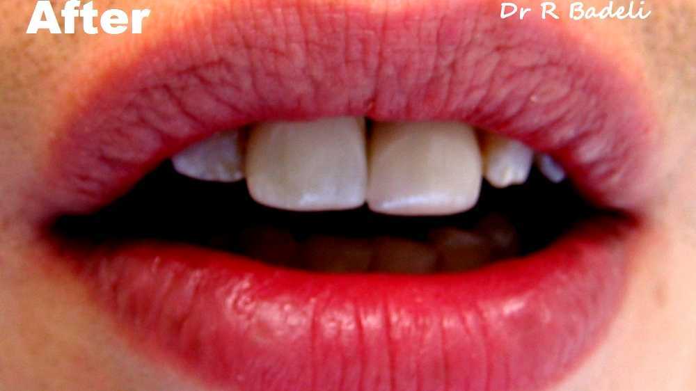 Resinretained bridge