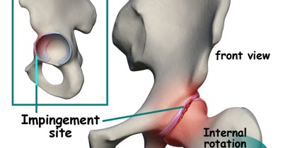 boka osteoarthritis kezelése az 1. fokozatú kezelés során