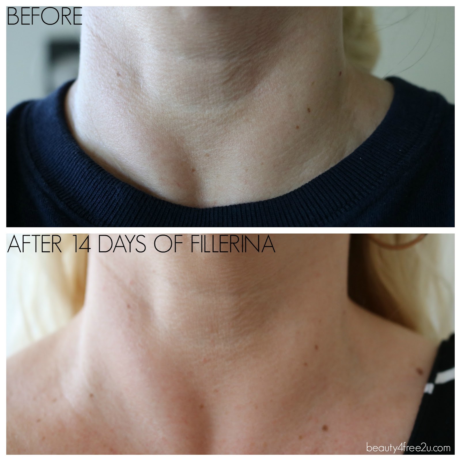 FILLERINA NECK AND CLEAVAGE TREATMENT REVIEW WITH BEFORE/AFTER