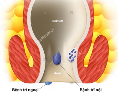 Bệnh trĩ