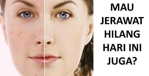 Cara Menghilangkan Jerawat Dengan Mudah Cara Menghilangkan Jerawat Dengan Mudah