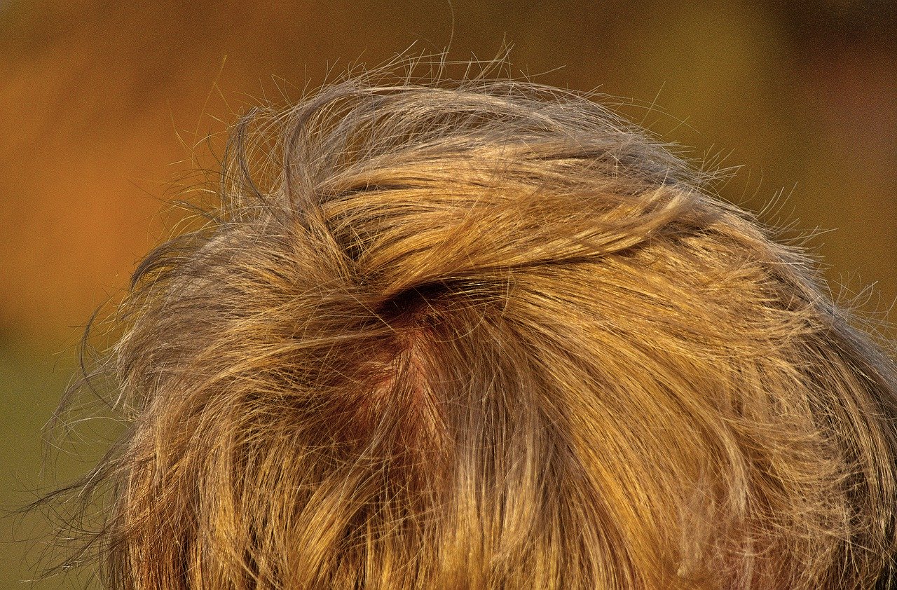 Transplante de Cabello Trasplante de Cabello Efectos Secundarios de los Microinjertos