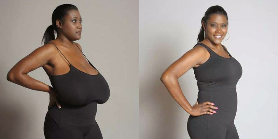 Woman With Breasts Weighing 7kg Each Undergoes Surgery To Reduce Them 